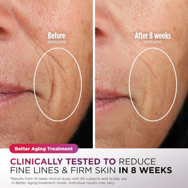 Shark CryoGlow LED Face Mask (FSA/HSA Eligible*) with Under-Eye Cooling, Anti-Ageing & Blemish Repair, Red & Blue LED, Infrared Light Therapy, USB-C, Remote Control, Storage Bag, Blue Frost, FW312