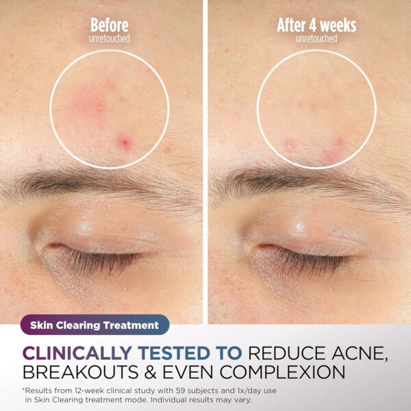 Shark CryoGlow LED Face Mask (FSA/HSA Eligible*) with Under-Eye Cooling, Anti-Ageing & Blemish Repair, Red & Blue LED, Infrared Light Therapy, USB-C, Remote Control, Storage Bag, Blue Frost, FW312