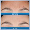 CeraVe Resurfacing Retinol Serum For Post Acne Marks, Formulated With Licorice Root Extract & Niacinamide, Brightening Serum & Pore Minimizer For Face, Post Acne Skin Barrier Repair, Non-Comedogenic