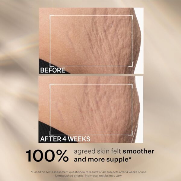 StriVectin SD Advanced™ Plus Intensive Moisturizer for Wrinkles & Stretchmarks, For Face & Body, Collagen Boosting with Peptides & Hyaluronic Acid