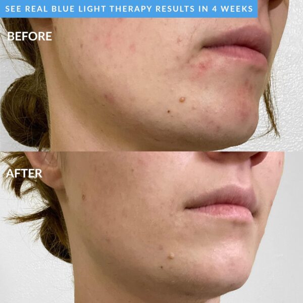 81VdrCMVNHL._SL1500_.jpg PMD Beauty Facial Cleansing Brush - Smart Silicone Brush with Blue Light Treatment - SonicGlow Vibration - Waterproof Device for Acne