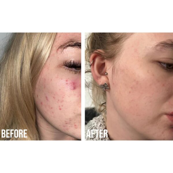 Nip+Fab Retinol Fix Blemish Gel Treatment 10% Complex, 0.5 fl. oz., 0.1% Ensapsulated Pure Retinol, 2% Niacinamide, 2% Trivalin, 0.5% Salicylic Acid to Target Blemishes, Dark Spots and Pore Size