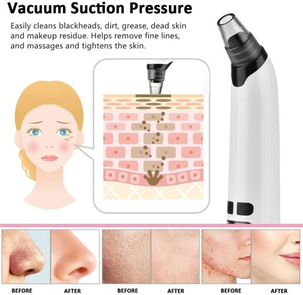 Advanced Electric Blackhead Remover Vacuum, Customizable Suction Levels, Interchangeable Heads, Ergonomic Design, Portable & USB-Chargeable, Electric Acne Extractor Tool, White
