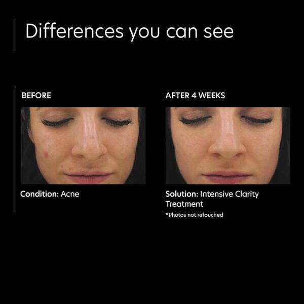 PCA SKIN Intensive Clarity Treatment - 0.5% Pure Vitamin A Retinol & 2% Salicylic Acid Face Serum for Acne-Prone Skin (1 oz)