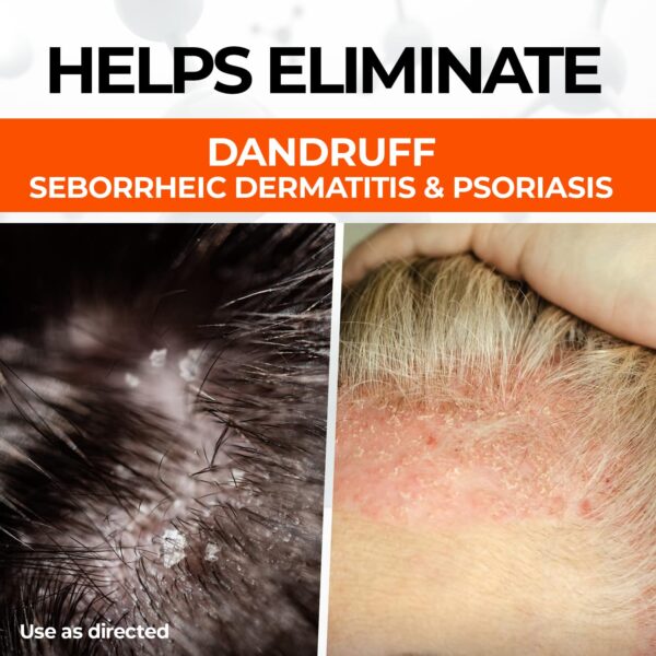 Medicasp Coal Tar Anti-Dandruff Shampoo, Alleviates Symptoms from 1st Wash, Treats Psoriasis, Seborrheic Dermatitis & Itchy Dry Scalp, Fights the Root Cause of Dandruff, Flakes Shampoo, 6 fl oz