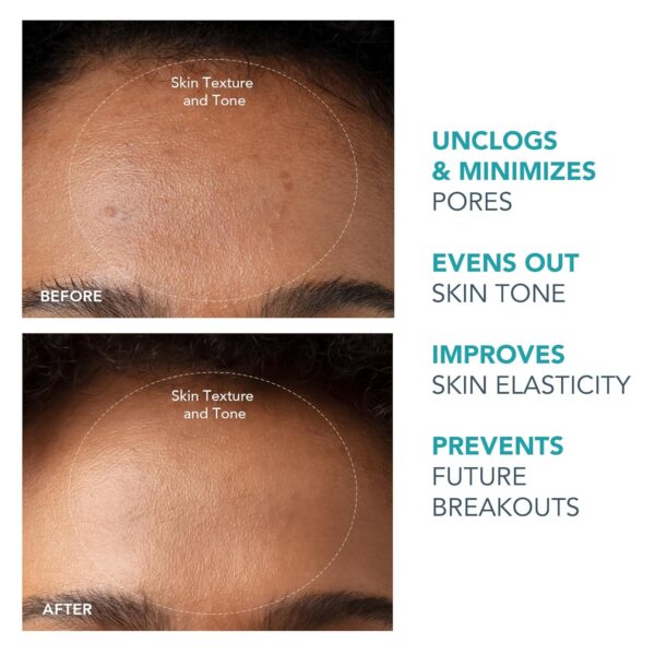 FOREO KIWI Whitehead & Black Head Remover for Face - Facial Skin Care Tools - Blackhead Extractor for Face & Nose - No Pore Strips Suction - Quick & Effective Blackhead Remover Device