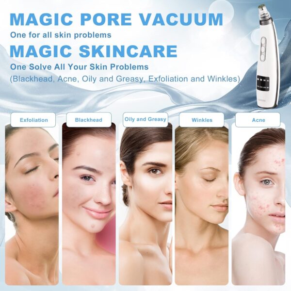 Blackhead Remover, EUASOO USB Rechargeable Pimple Extractor, Electric Pore Vacuum Blackhead Remover Tools for Women & Men, Blackhead Vacuum Kit with 10 * Filter Sponge & 5 * Rubber Ring & etc.