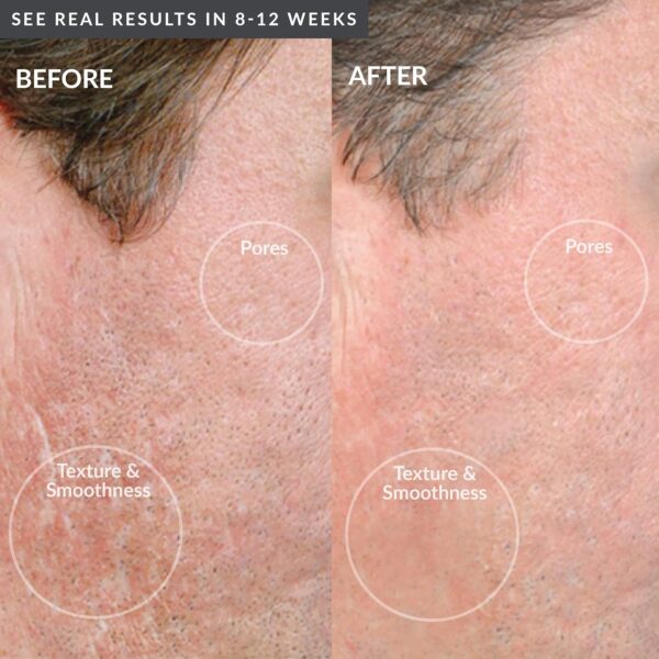 PMD Beauty Personal Microderm Man - At-Home Microdermabrasion Machine with Kit for Face & Body - Exfoliating Crystals and Vacuum Suction for Bold and Striking Skin