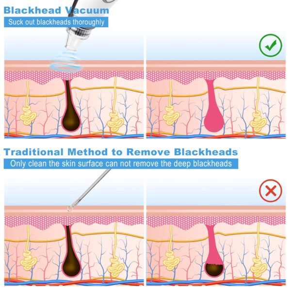 Blackhead Remover, EUASOO USB Rechargeable Pimple Extractor, Electric Pore Vacuum Blackhead Remover Tools for Women & Men, Blackhead Vacuum Kit with 10 * Filter Sponge & 5 * Rubber Ring & etc.