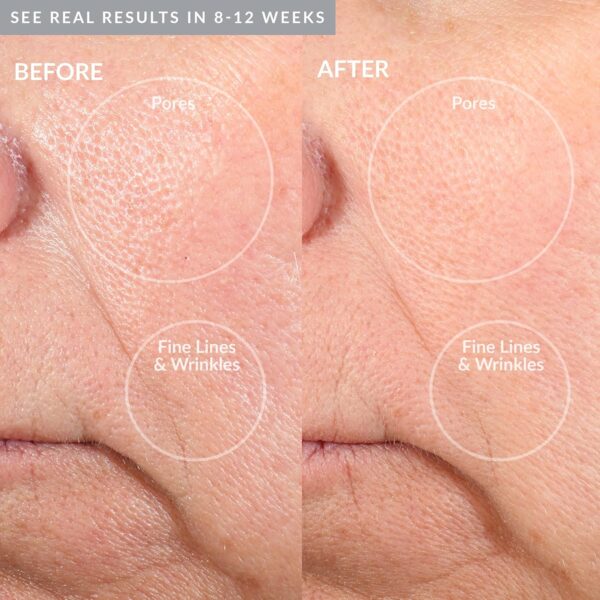 PMD Personal Microderm Pro - At-Home Microdermabrasion Machine with Kit for Face & Body - Exfoliating Crystals and Vacuum Suction for Fresh and Radiant Skin - High & Low Speed Options