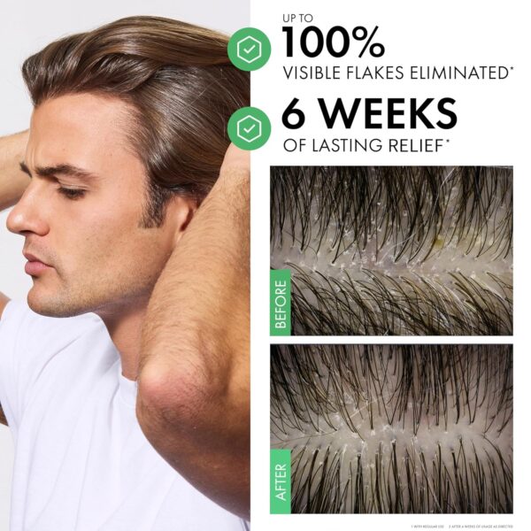 Dercos Selenium Sulfide Anti Dandruff Shampoo, Dry Scalp Treatment and Itch Relief. Prescription Strength Comparable to 2% Ketoconazole, for Mild to Severe Dandruff-Prone Hair & Flaky, Itchy Scalps