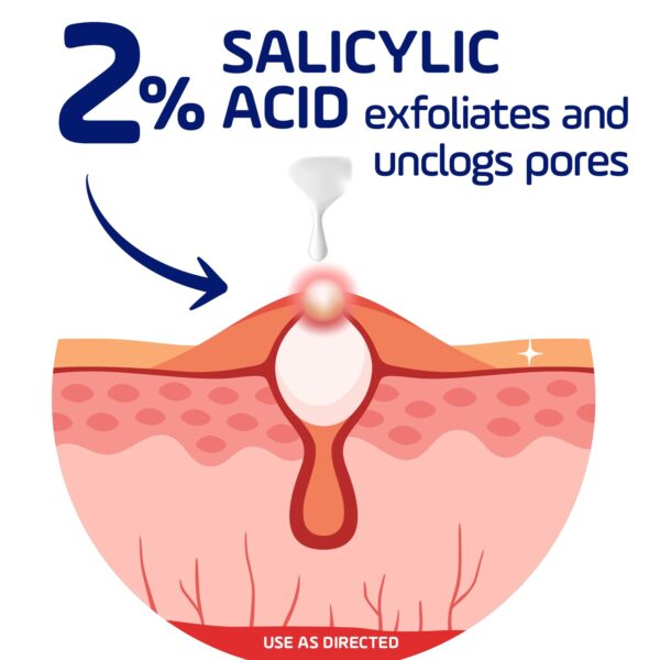 Asepxia Acne Treatment Cream for Face, 2% salicylic acid, Rapid Maximum Strength Acne Treatment, Clears Pimples and Blackheads, Prevents New Acne and Controls Excess Oil, 1 oz (Pack of 3)