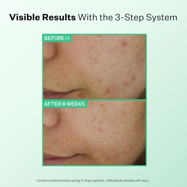 StriVectin Multi Action Clear for Acne and Blemish Prone Skin for Clearer, Smooth and Brighter Skin, Less Breakouts and Pimples for Healthy Looking Skin