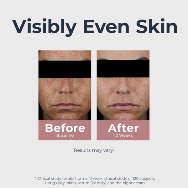 711rshMaUfL._SL1500_.jpg Eucerin Radiant Tone Dual Serum Dark Spot Corrector, Dark Spot Serum with Thiamidol and Hyaluronic Acid, Helps Visibly Reduce the Look of Persistent Dark Spots, 1 Fl Oz Bottle