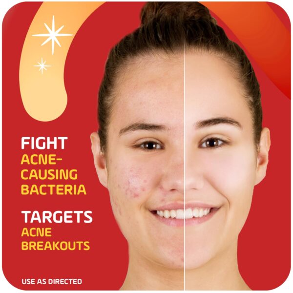 Asepxia Acne Treatment Cream for Face, 2% salicylic acid, Rapid Maximum Strength Acne Treatment, Clears Pimples and Blackheads, Prevents New Acne and Controls Excess Oil, 1 oz (Pack of 3)