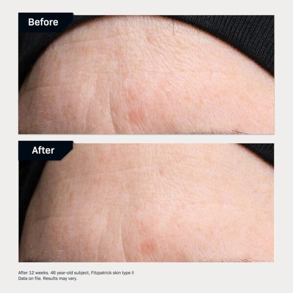 Revision Skincare Revox™ Line Relaxer, Targeted Under Eye Serum with Hyaluronic Acid, Improves Fine Lines and Wrinkles