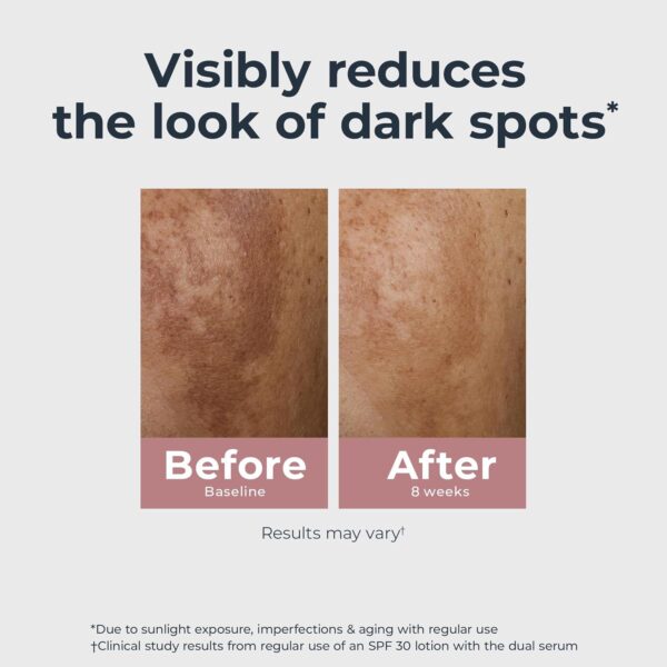 71fYZVnb30L._SL1500_.jpg Eucerin Radiant Tone Dual Serum Dark Spot Corrector, Dark Spot Serum with Thiamidol and Hyaluronic Acid, Helps Visibly Reduce the Look of Persistent Dark Spots, 1 Fl Oz Bottle