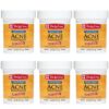 De La Cruz Sulfur Ointment - Cystic Acne Treatment for Face and Body - Daily 10 Min Spot Treatment Mask - Safe and Effective Game Changing Hormonal Acne Treatment that Clears Up Pimples 2.6oz (6 Pack)